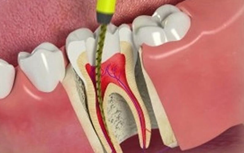 Affordable root canal near me