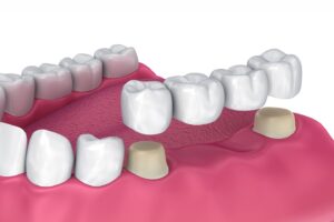 dental bridge in houston 77023