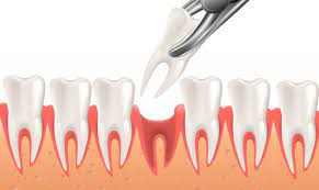 tooth extraction near Houston 77023