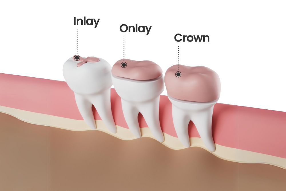 Inlays and Onlays