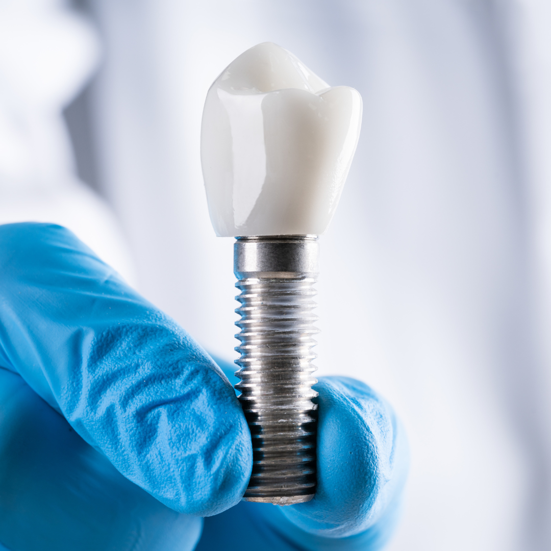 Mini Dental Implants