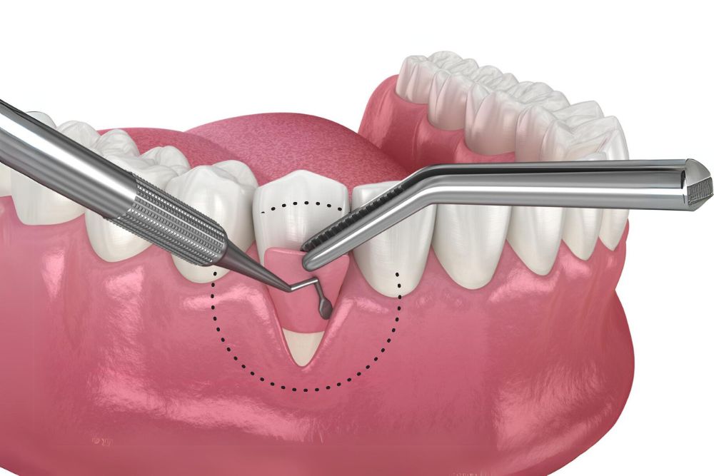 Soft-Tissue Grafting