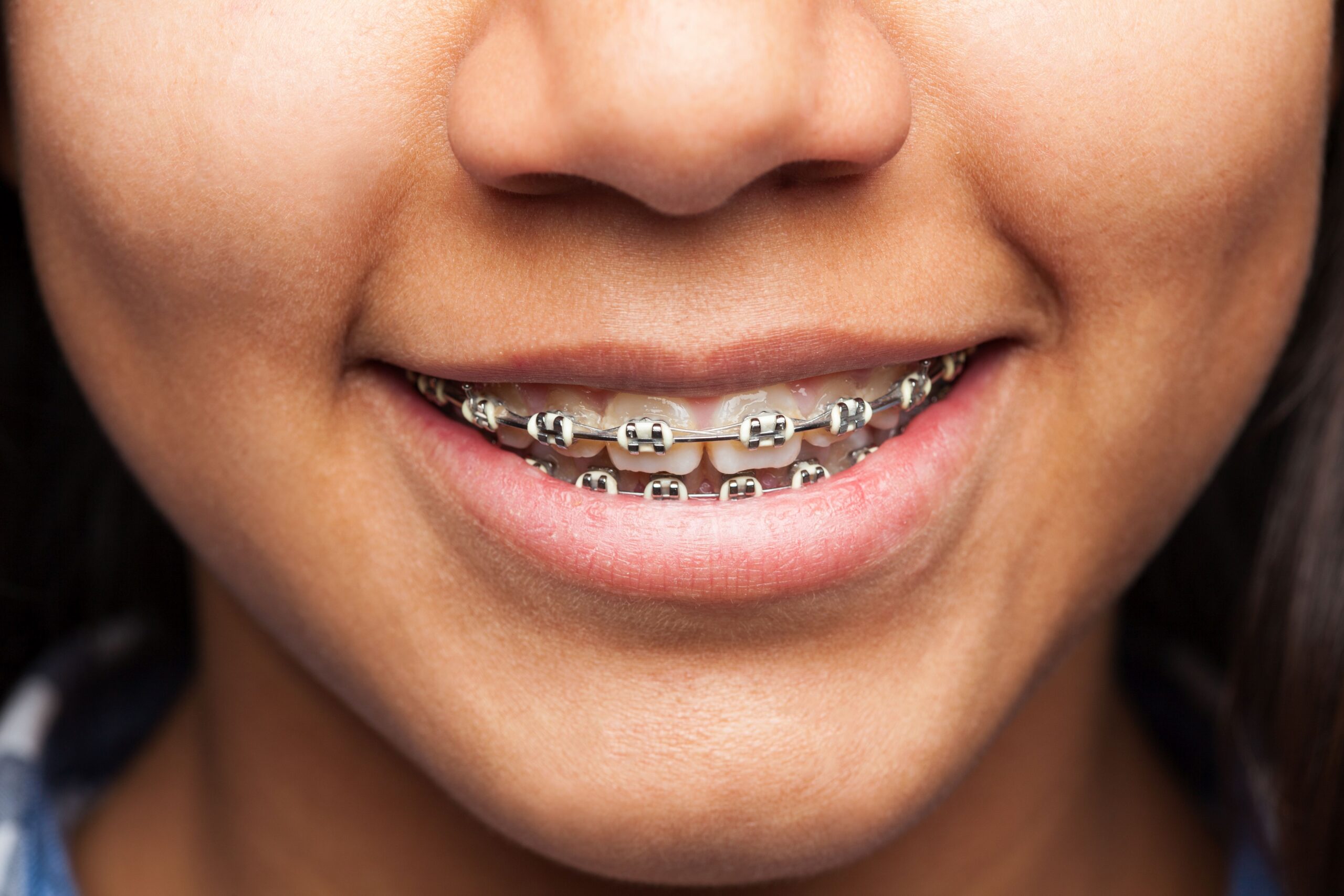 latin girl's mouth with brackets