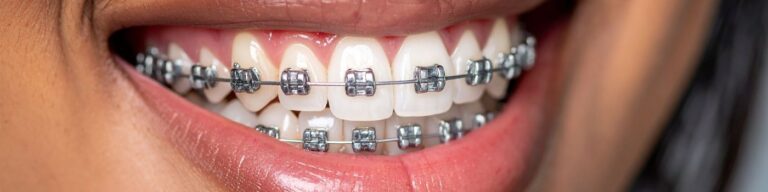Top Benefits of Orthodontic Treatment Beyond Straight Teeth