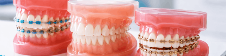 Types of Braces Explained: Metal, Ceramic, and Lingual Braces