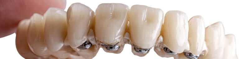 Stronger, Smarter, Better: How Advanced Dental Bridges Are Changing Tooth Replacement