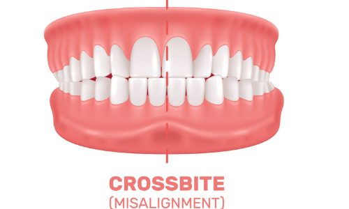 Cross bite