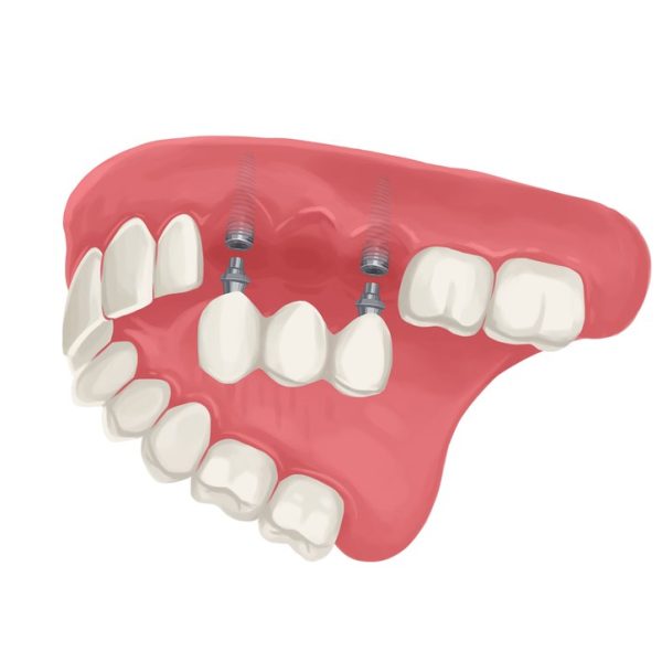 Dental Bridge Page